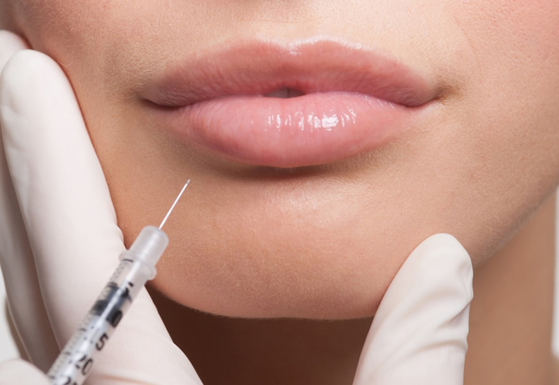 Hyaluronic fillers 