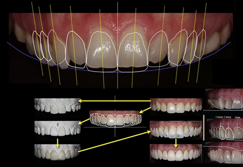 Digital Smile Design